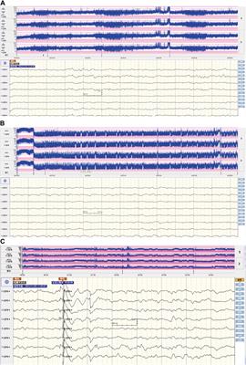 Case report: Acute severe hyponatremia-induced seizures in a newborn: a community-acquired case and literature review